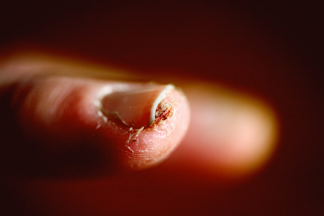 découvrez le coût du traitement d’un ongle incarné : tarifs moyens, facteurs de prix, options de soins et conseils pour choisir la meilleure solution adaptée à votre budget.